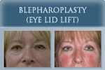 Blepharoplasty - Photo
