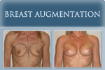 Breast Augmentation - Photo
