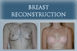 Breast Reconstruction - Photo