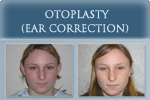 Otoplasty - Photo