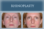 Rhinoplasty - Photo